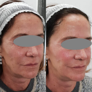 Before and after comparison showing the effectiveness of V Carbon System skincare treatment.